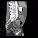 Carcinomatous peritonitis, mixed tumour of appendix, carcinoid and adenocarcinoma: CT - Computed tomography